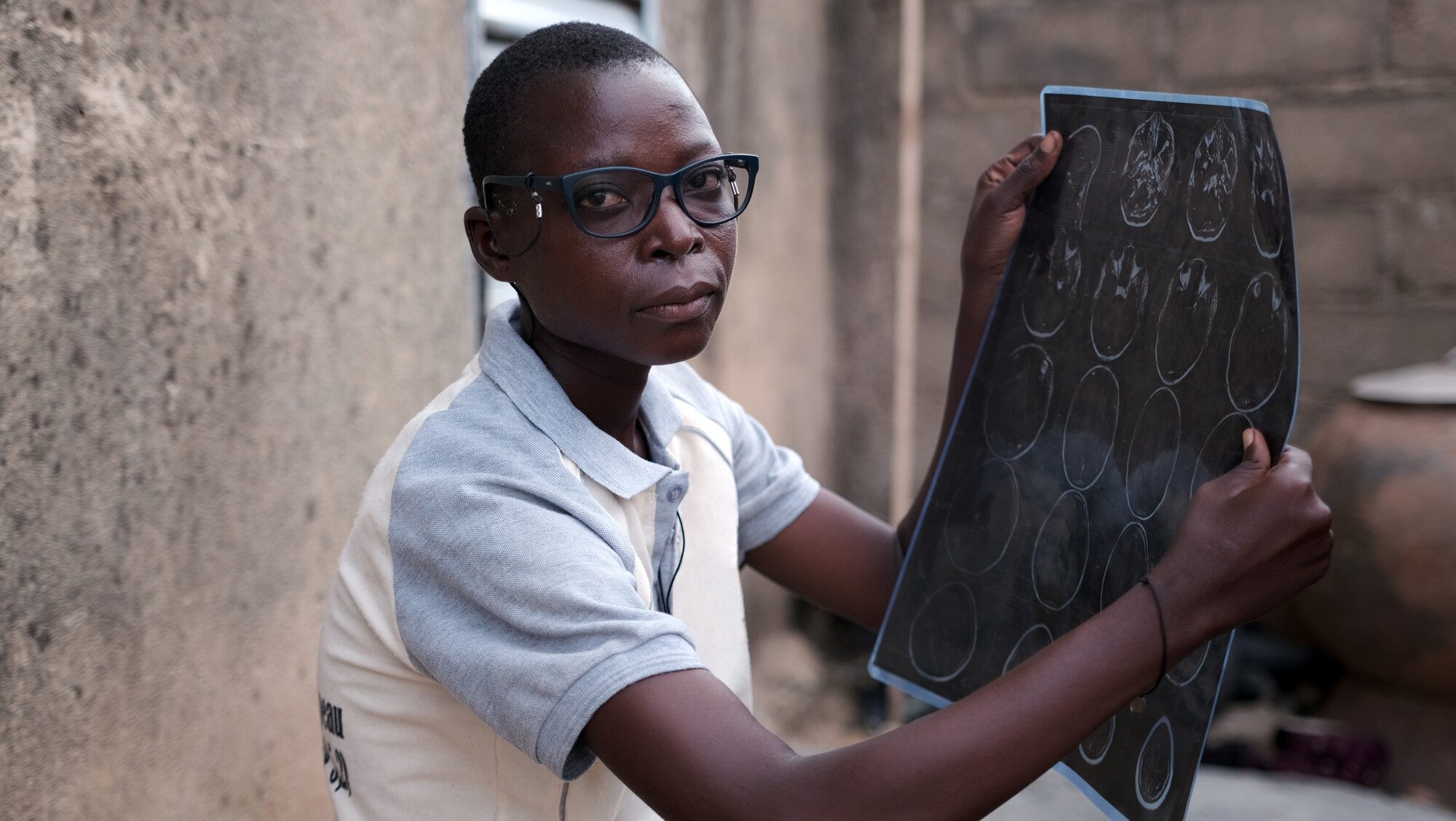 Valentine, 30, looks at the x-rays used to diagnose her condition. Despite her disability, Valentine has managed to earn a living